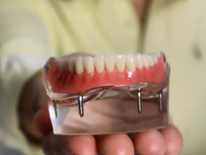 Modelo de prótese protocolo, com a arcada de dentes presa a quatro implantes