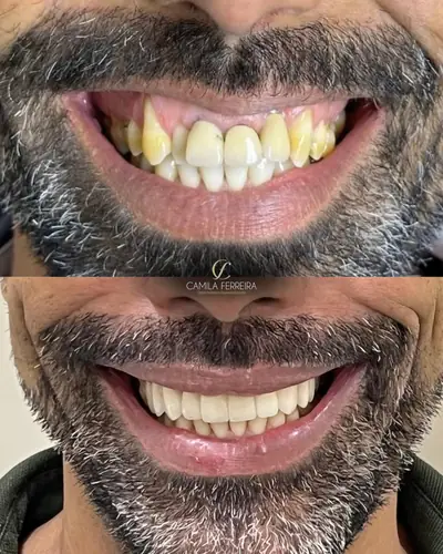 Sorriso antes do tratamento, em cima, e depois, embaixo