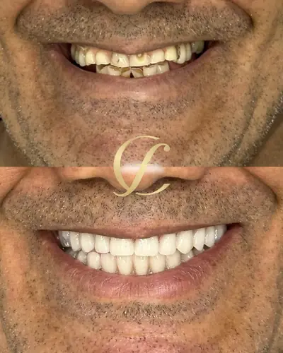 Dentes desgastados antes, em cima, e sorriso refeito depois, embaixo
