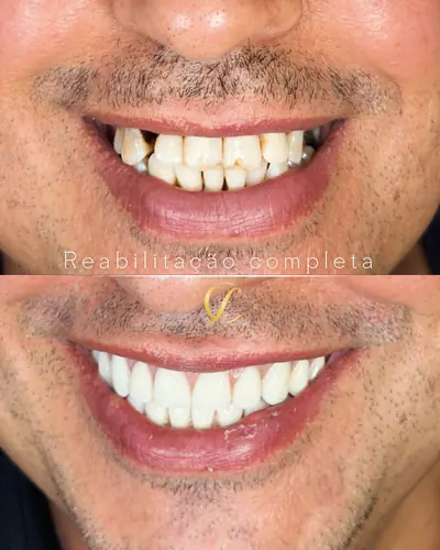 Sorriso com falhas antes, em cima, e completo depois, embaixo