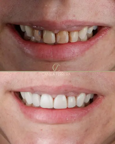 Dentes manchados antes, em cima, e sorriso claro depois, embaixo